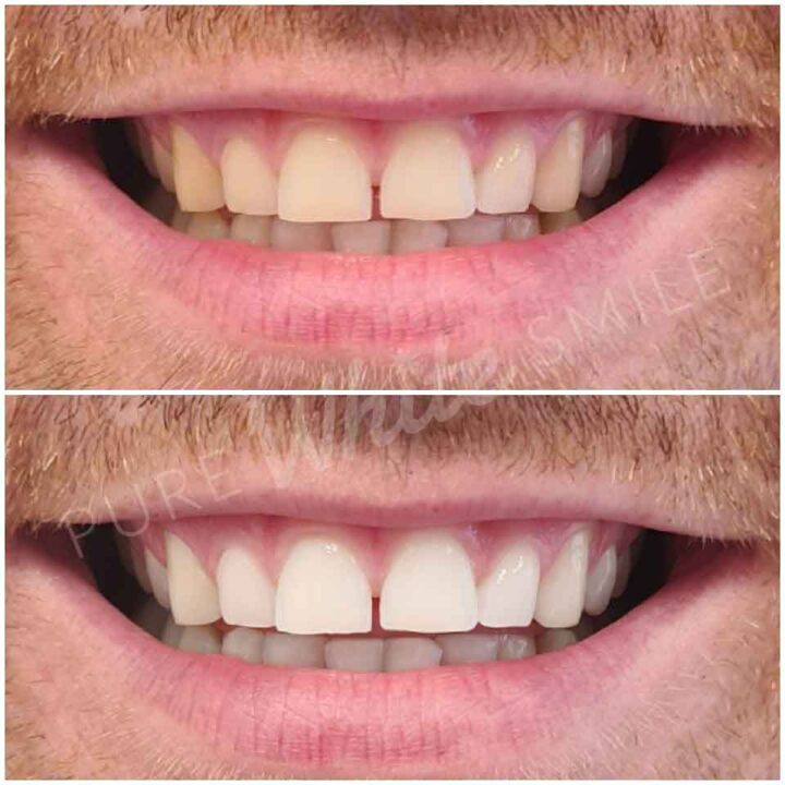 A close up before and after photo of a client’s smile after completing a laser teeth whitening treatment at Pure White Smile in Chorley.