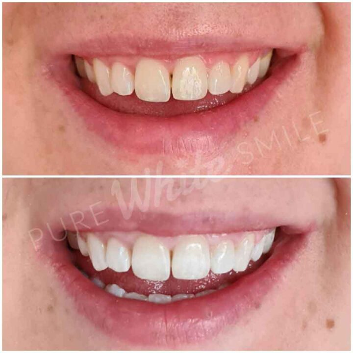 Before and after image showing the results of non-peroxide laser teeth whitening at Pure White Smile in Chorley, Lancashire.