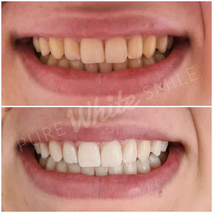 A client’s teeth before and after laser whitening, demonstrating stain removal and brighter results at the Pure White Smile clinic in Chorley.