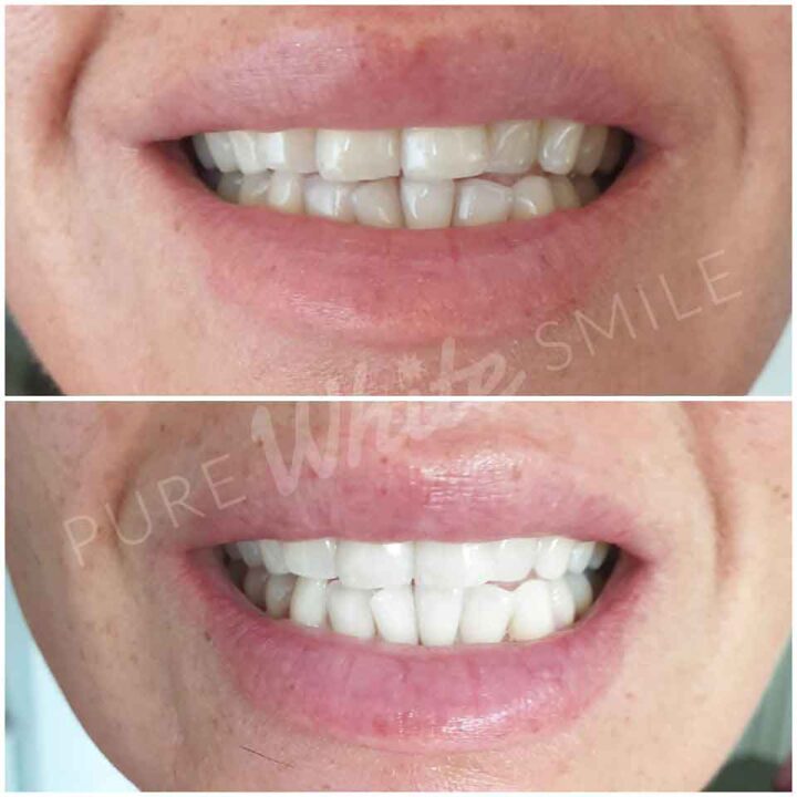 A comparison photo showing improved tooth colour after laser teeth whitening at Pure White Smile in Chorley.