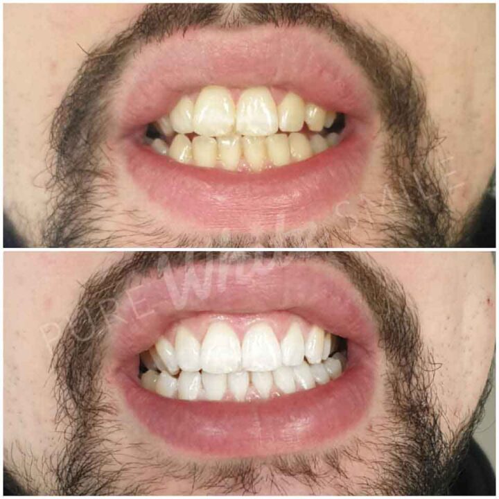 Before and after teeth whitening results from a client treated with advanced laser technology at Pure White Smile in Chorley, Lancashire.