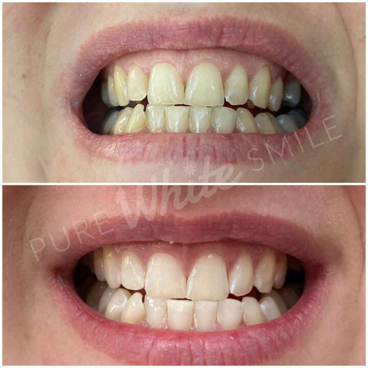 A side by side image highlighting a smile transformation after a laser teeth whitening session at Pure White Smile in Chorley.
