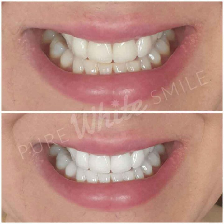 A client’s smile before and after professional laser teeth whitening at the Pure White Smile clinic in Chorley, showing a brighter and whiter result.
