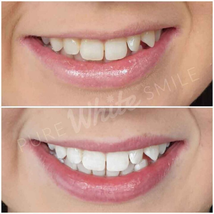 Before and after photo showing visible tooth shade improvement following a laser teeth whitening treatment at Pure White Smile in Chorley, Lancashire.
