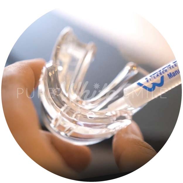 A client applying the Blu Forsa non-peroxide teeth whitening gel into a protective mouthguard as part of step 4 of the laser teeth whitening process at Pure White Smile in Chorley.
