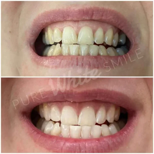 A photo of a client's teeth showing different tooth discolouration, including surface and deeper stains, before and after laser teeth whitening at Pure White Smile in Chorley.