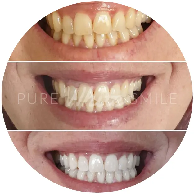 Professional laser teeth whitening working on surface and deeper tooth discolouration at Pure White Smile in Chorley.